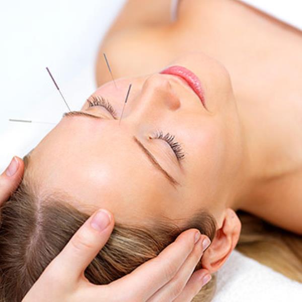 woman getting acupuncture