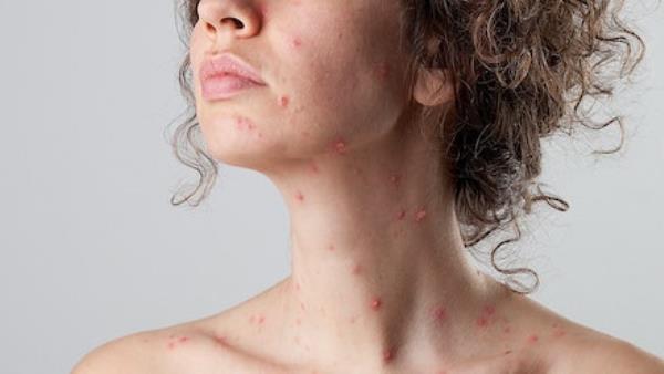 woman with chickenpox