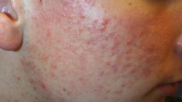 Co<em></em>ntact dermatitis