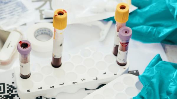 实验性血液检查可能有助于早期发现结肠癌