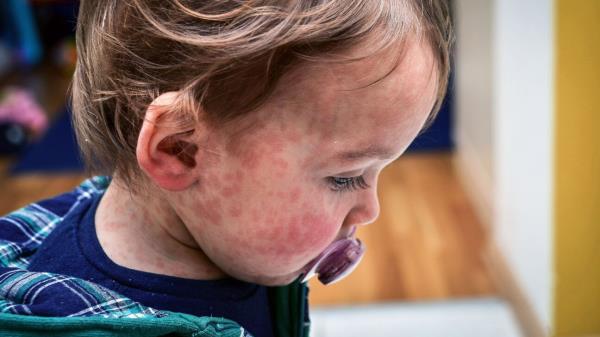 疾病预防控制中心发布警报并敦促接种麻疹疫苗